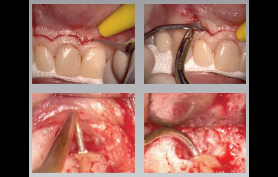 Dr. Castellucciho přístup k mikrochirurgické endodoncii je přímočarý a čistý 