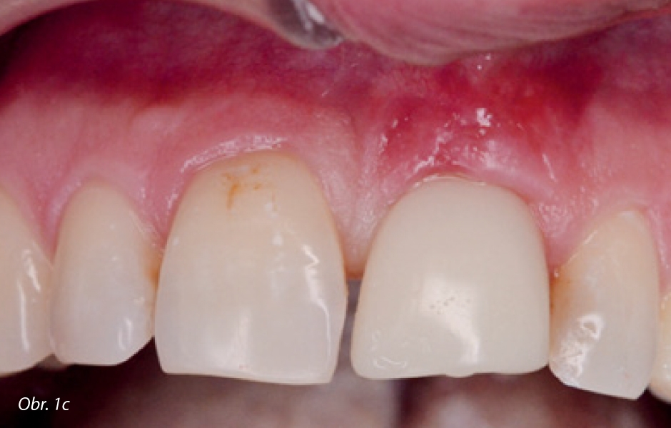 Autologní dentin – nová generace augmentačních materiálů