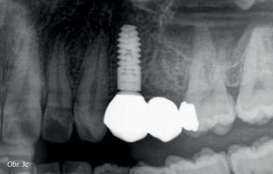 Autologní dentin – nová generace augmentačních materiálů