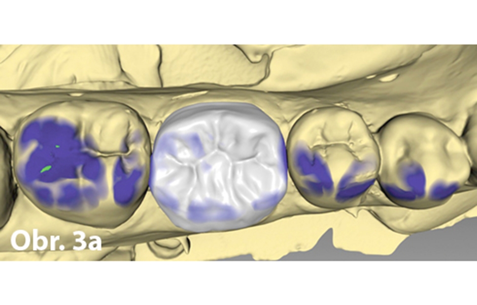 Návrh korunky v softwaru (CEREC inLab) a zkouška v ústech před krystalizačním pálením (IPS e.max CAD)