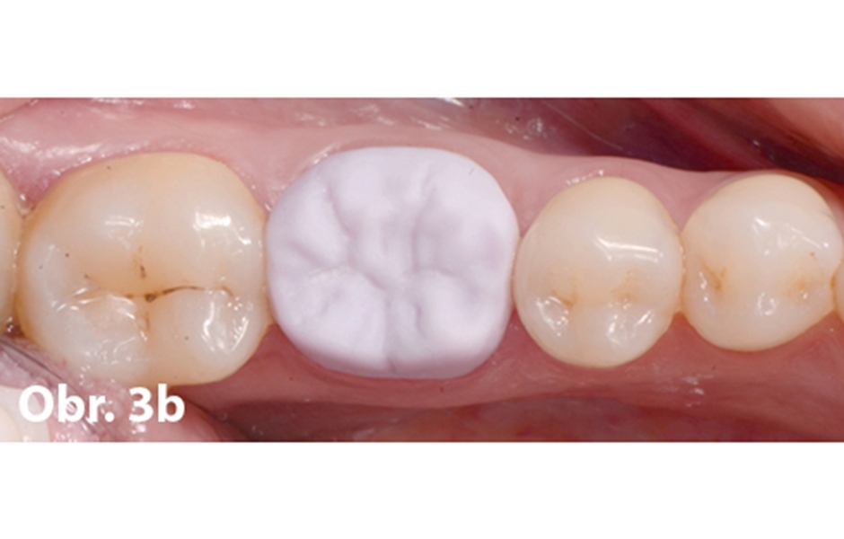 Návrh korunky v softwaru (CEREC inLab) a zkouška v ústech před krystalizačním pálením (IPS e.max CAD)