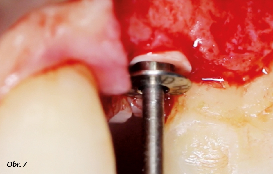 Umístění krycího šroubku na zanořený implantát