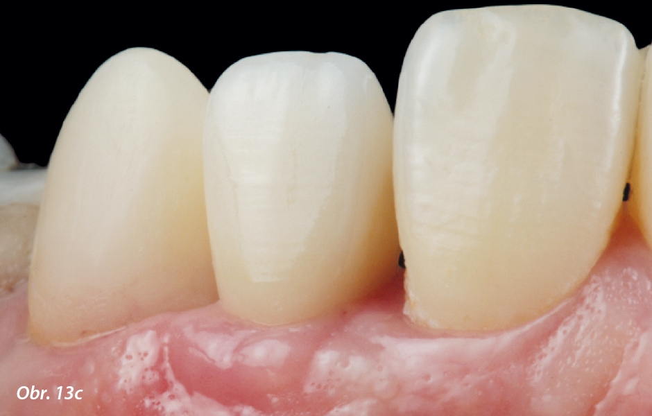 c) výsledek rehabilitace zubu 22 implantátem