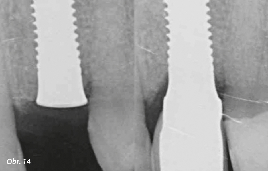 Rentgenový snímek ihned po implantaci (vlevo) a po vhojení s nacementovanou korunkou (vpravo)