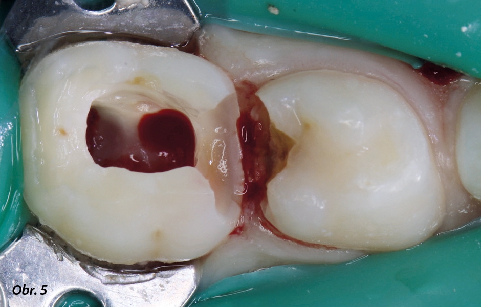 Situace před ošetřením – Dosažení hemostázy (obr. 5).