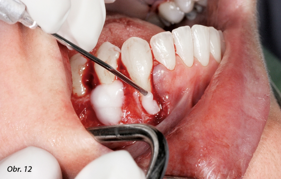 Dehiscence bukální kosti u lokalizovaných parodontálních infekcí