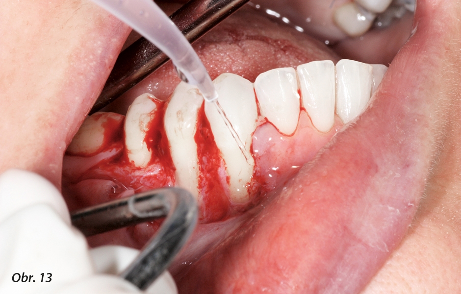 Dehiscence bukální kosti u lokalizovaných parodontálních infekcí