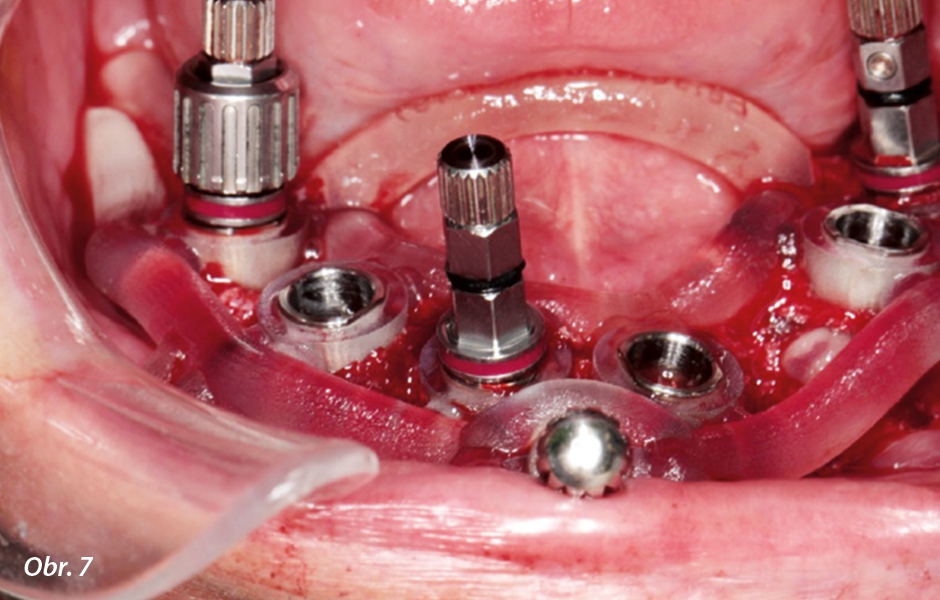 Implantace přes chirurgickou šablonu.