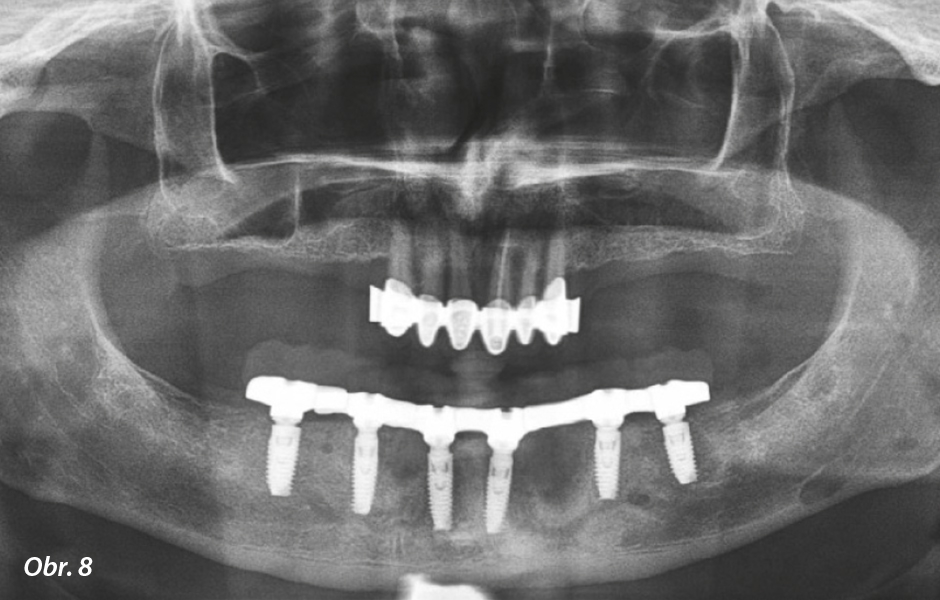 Kontrolní OPG ihned po implantaci