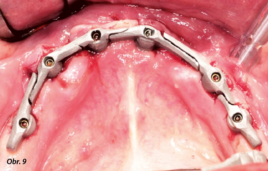 Dělený třmen bezprostředně po implantaci in situ.