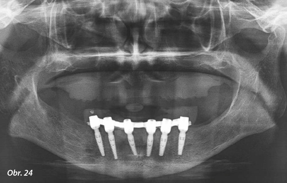 Kontrolní OPG ihned po implantaci.