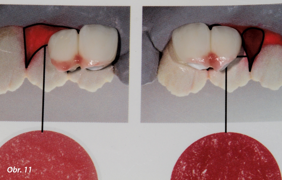 Závěrečná kontrola umístění různých odstínů růžové gingivy na snímcích defektu.
