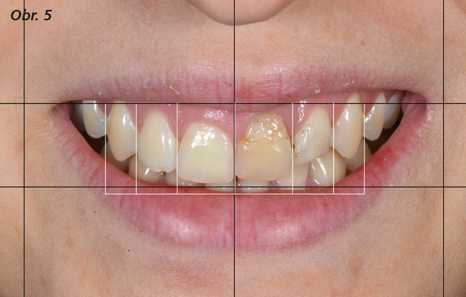 Linie zakreslené na okrajích každého frontálního zubu, osy zubů a okraje rtů