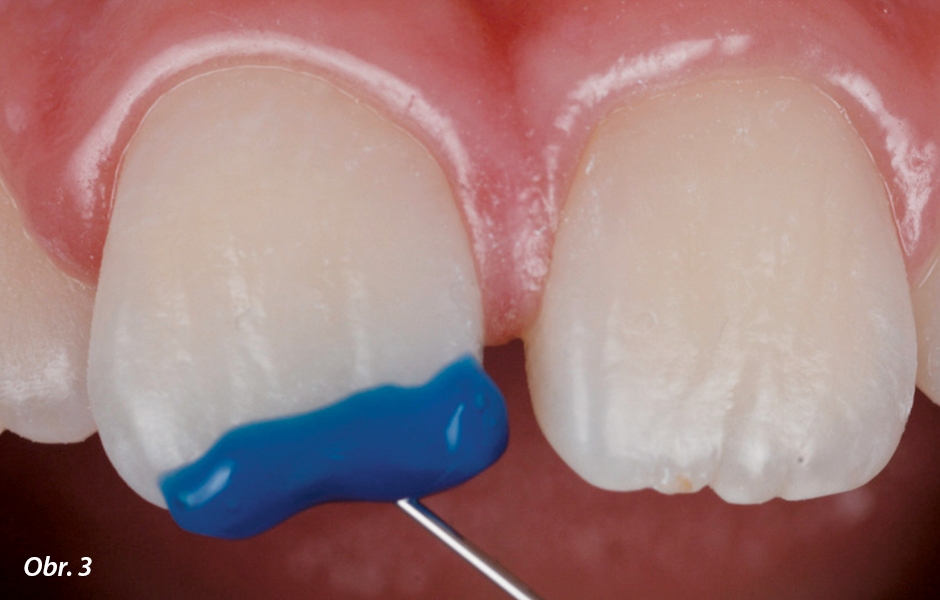 Po pečlivém očištění extratenkým tvarovacím a lešticím diskem 3M™ Sof-Lex™ (hrubá zrnitost) byl zub naleptán po dobu 15 sekund univerzálním leptadlem 3M™ Scotchbond™ Universal Etchant a oplachován po dobu 20 sekund