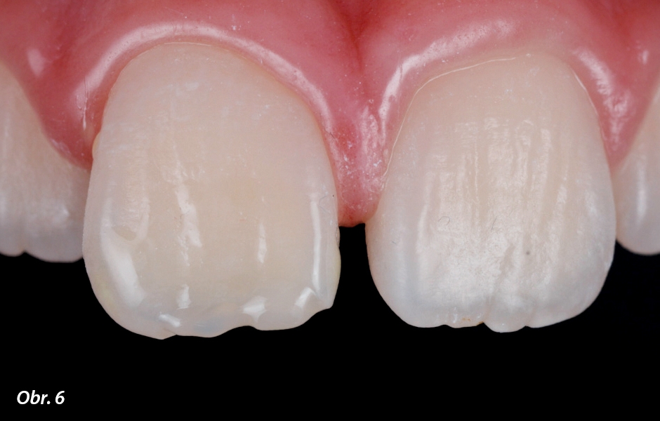 První vrstva zatékavého výplňového materiálu 3M™ Filtek Flowable Restorative před světelným vytvrzením – všimněte si, že je materiál na zubu stabilní (nestéká ani neodkapává)
