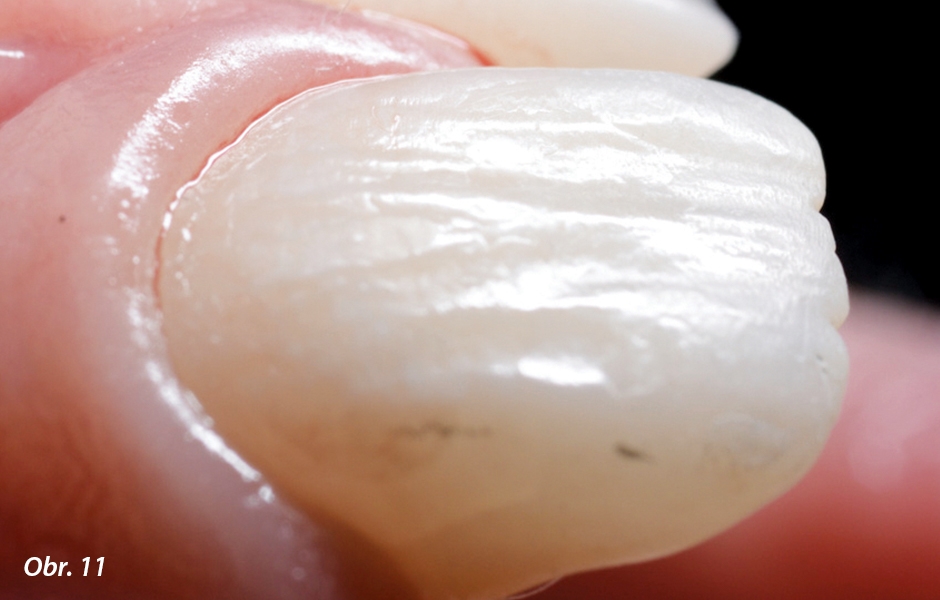 Všimněte si, že okraje dostavby jsou neznatelné, a to i bez nutnosti preparace zubu, díky vynikající vlastnosti adaptace materiálu 3M™ Filtek Flowable Restorative k přirozené struktuře zubu