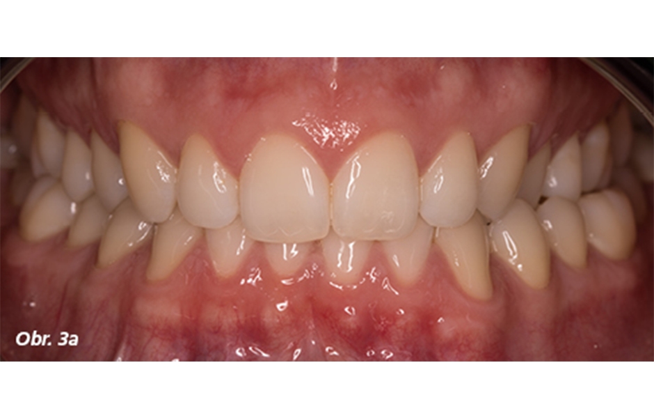 Digitální dentální fotografie – III. část