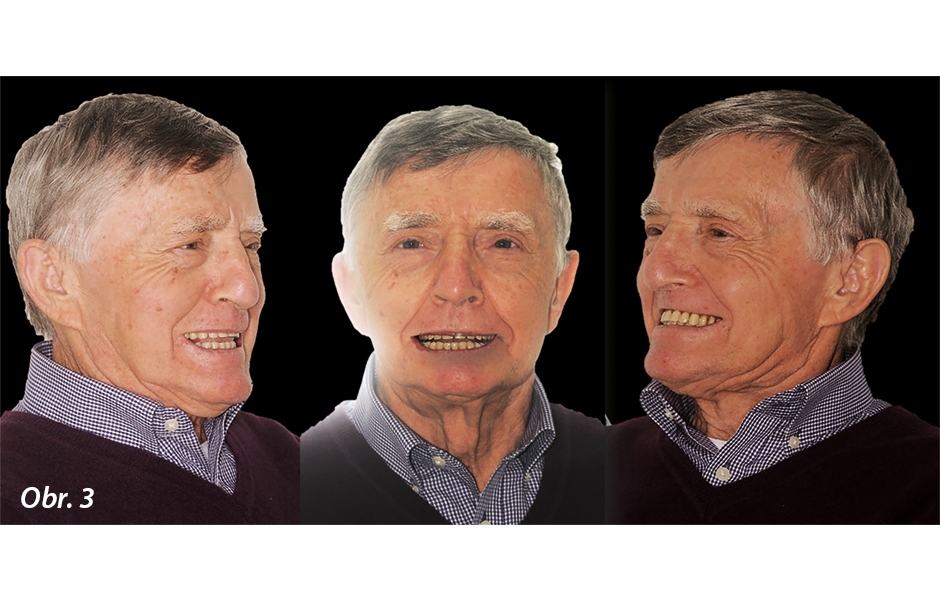 Hodnocení tváře ze sagitálního pohledu zdůrazňuje distálně skloněnou okluzní rovinu s intraorálními charakteristikami, které lze přisuzovat Kellyho syndromu 