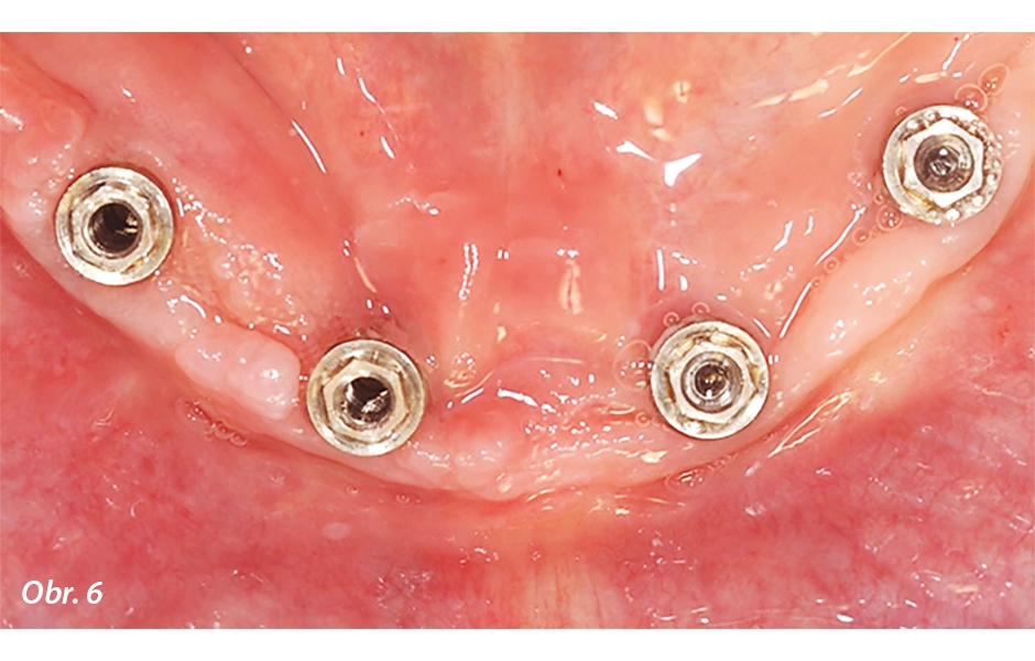 Když jsou třmen a protetické komponenty odstraněny, můžeme vidět dobrý stav perimplantátových měkkých tkání: implantáty jsou oseointegrované