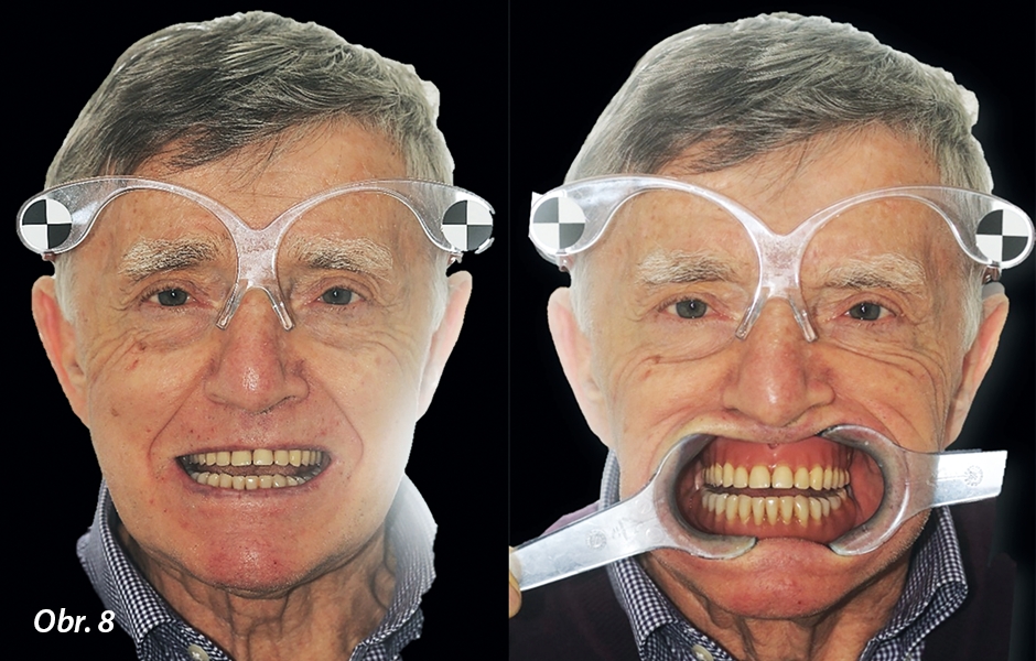 Jednoúčelové brýle používané pro kalibraci digitálního předběžného plánovacího softwaru, které má pacient nasazené, když se provádí fotografie obličeje