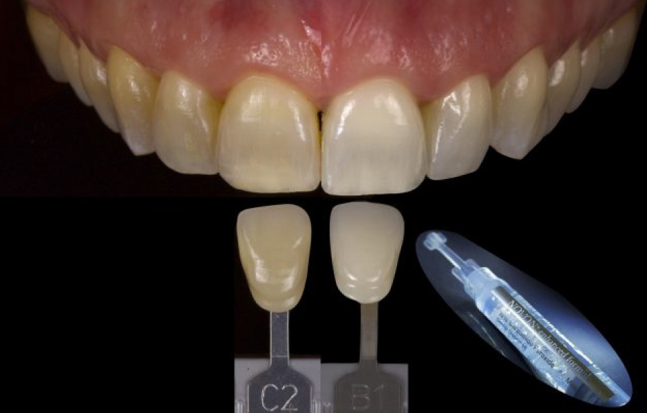 Obr. 8: Proces domácího bělení