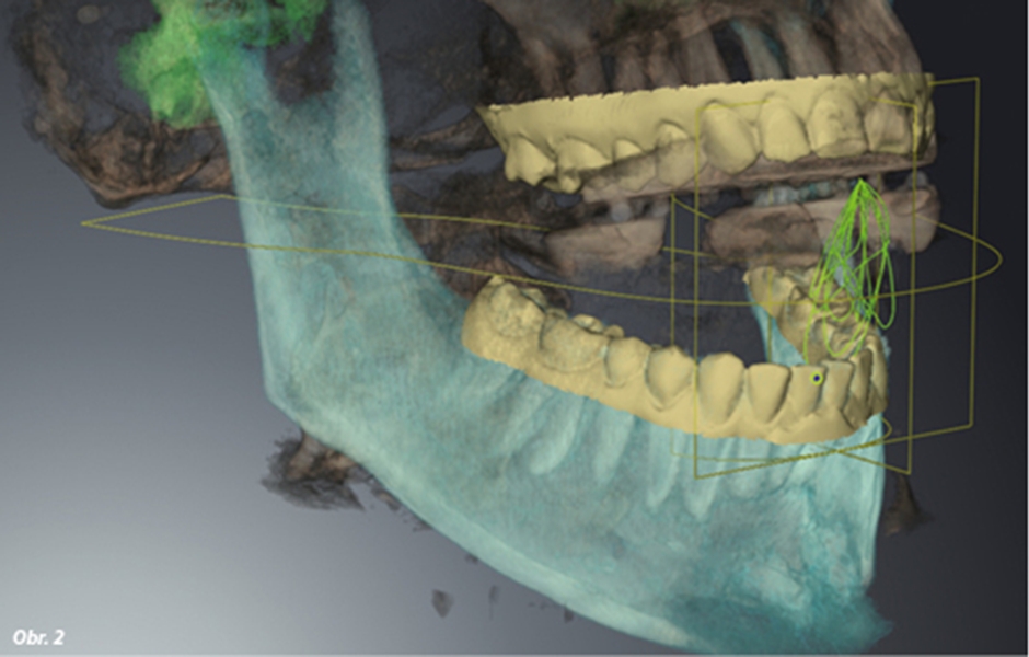 Příklad současných možností se záznamy žvýkací funkce, intraorální skeny a digitální objemová tomografie (SICAT Function, SICAT, Německo)