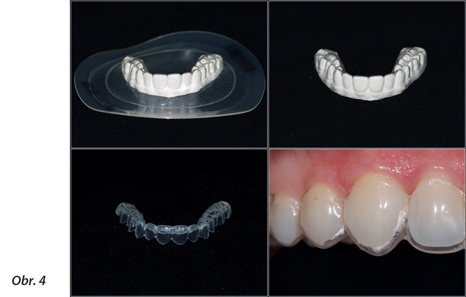 Model bez báze umožňuje zhotovení přesnějších individuálních nosičů (např. SCHEU-DENTAL GmbH, BIOPLAST Bleach), a to za pomoci ordinačního přístroje pro vakuové tvarování (SCHEU-DENTAL GmbH, Twinstar V).