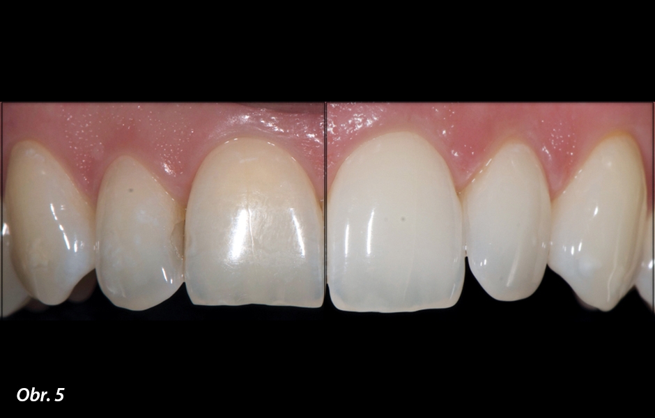 Strategie ošetření s produktem White Dental Beauty s obsahem 6% peroxidu vodíku