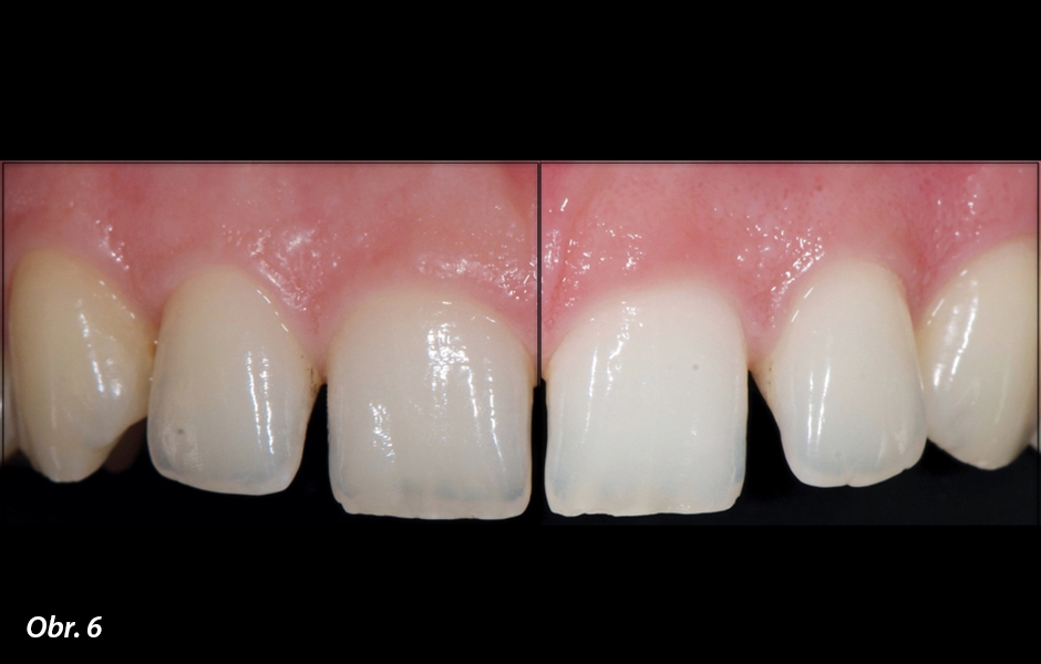 Strategie ošetření produktem White Dental Beauty s obsahem 5% karbamid peroxidu
