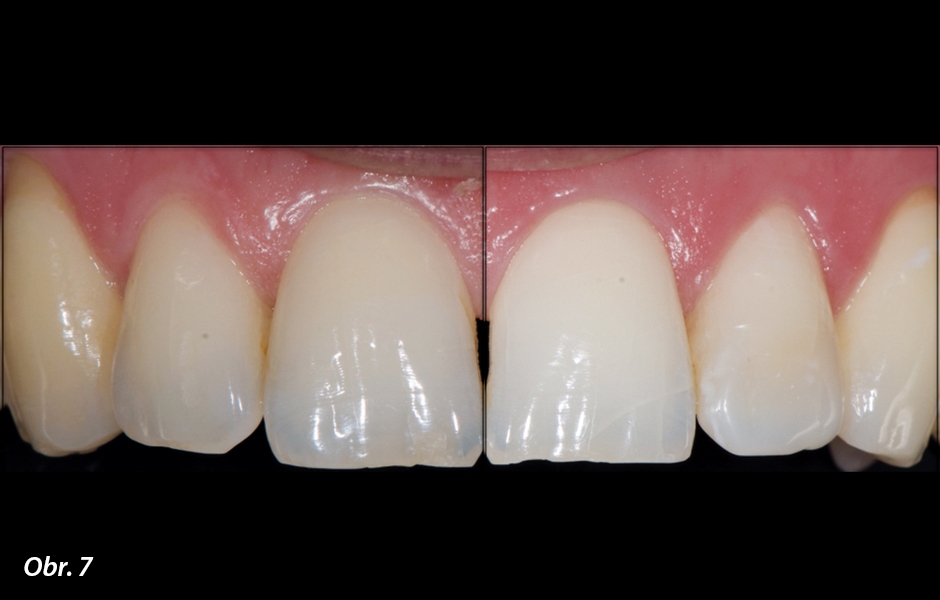 Strategie ošetření produktem White Dental Beauty s obsahem 6% peroxidu vodíku
