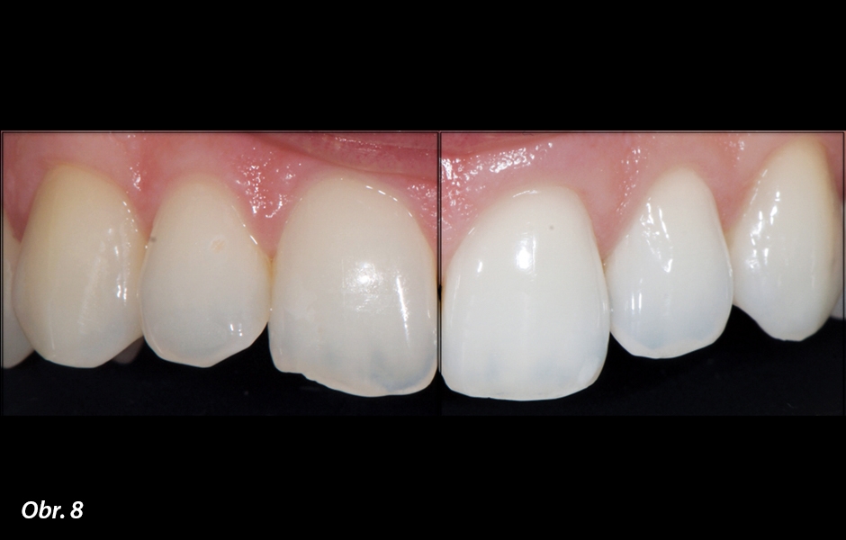Strategie ošetření produktem White Dental Beauty s obsahem 6% peroxidu vodíku