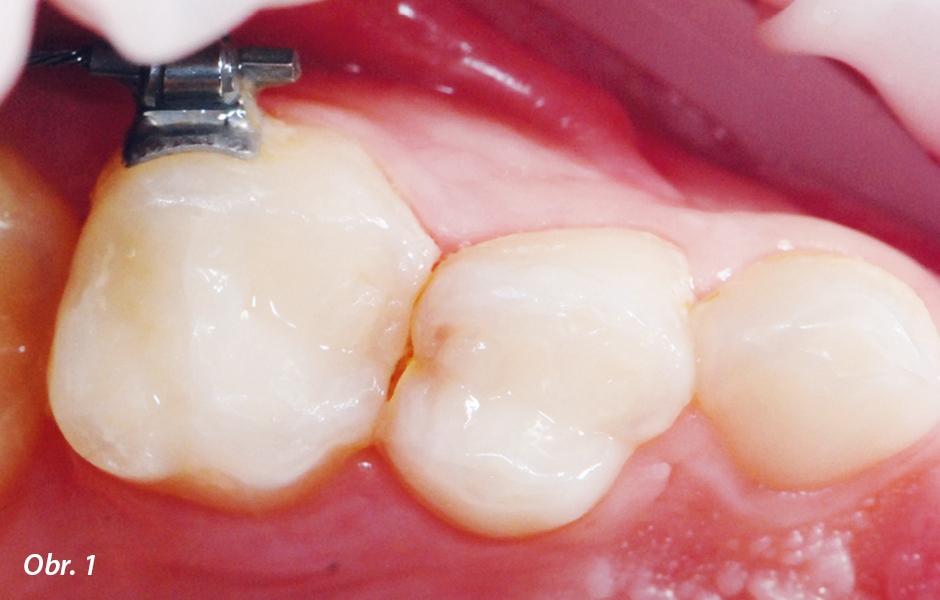 Situace před ošetřením: distální kaz v zubu 54