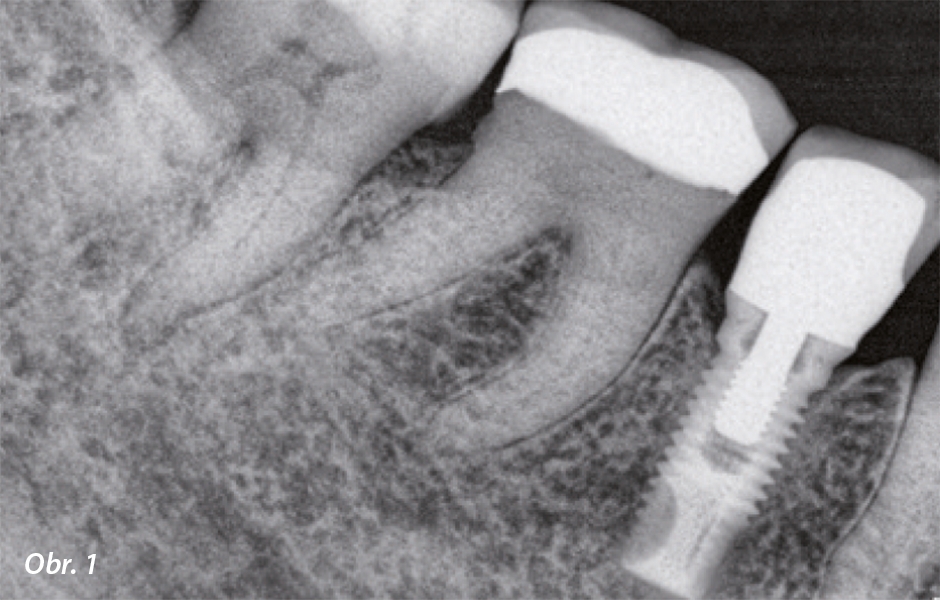 Předoperační snímek. Rozšíření PDL na meziálním kořeni zubu 47. PDL bez patologického nálezu kolem zubu 46.