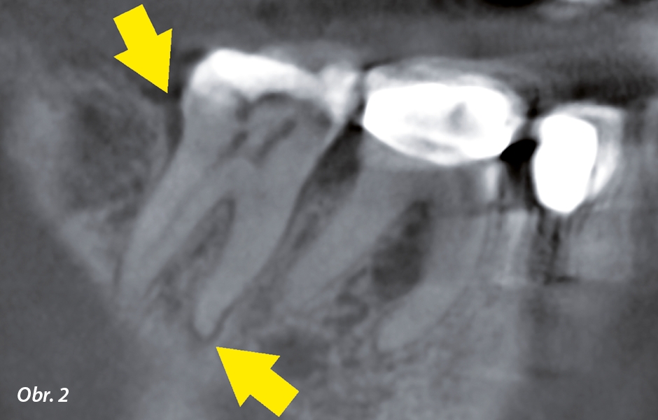 Sagitální řez CBCT. Rozšíření PDL kolem meziálního kořene zubu 47 a parodontální defekt distálně (šipka). Šíře defektu ukazuje na pravděpodobnou parodontální etiologii, nikoliv vertikální frakturu.
