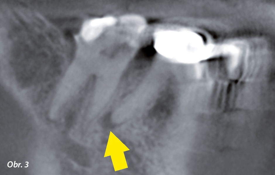 Sagitální řez CBCT. Na apexu distálního kořene zubu 46 je viditelné projasnění o průměru 2,5 mm. Také je vidět rozšíření PDL na distálním kořeni zubu 47.