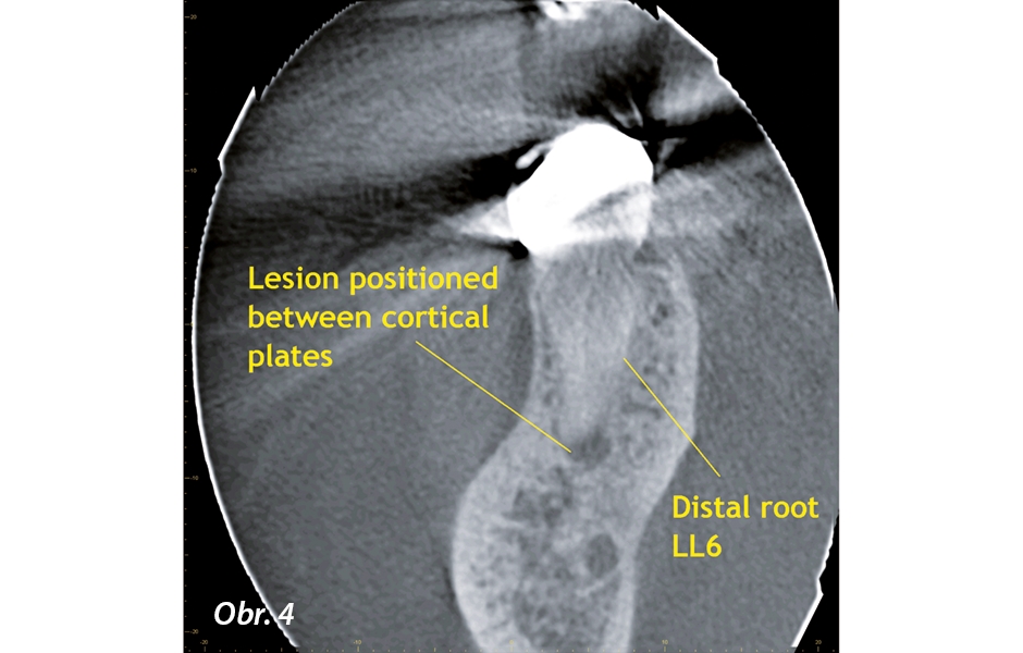 Koronální řez CBCT. Léze distálního kořene zubu 46 je lokalizována mezi obě kortikální lamely, a tím se stává pro tradiční 2D zobrazení neviditelnou.