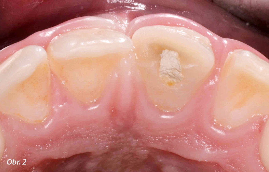 Endodontické ošetření horního středního řezáku s atypickou anatomií