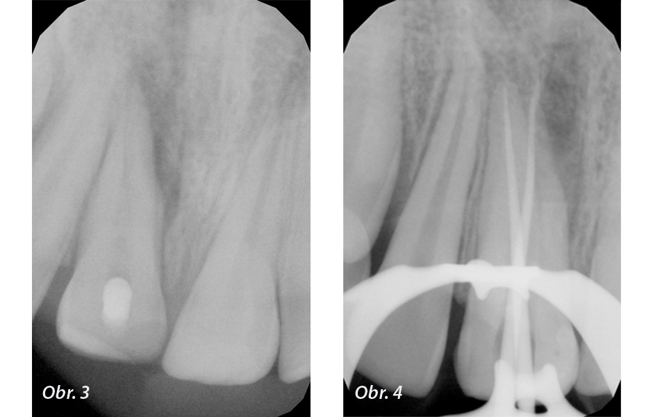 Endodontické ošetření horního středního řezáku s atypickou anatomií