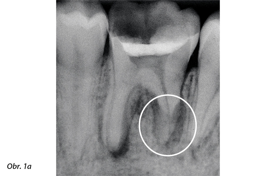 Vstupní rentgenové vyšetření zubu 36 ukazuje periapikální lézi u obou kořenů a závažnou apikální resorpci distálního kořene (kroužek).