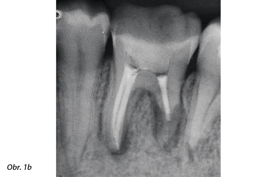 Zub 36 po zaplnění systému kořenových kanálků.