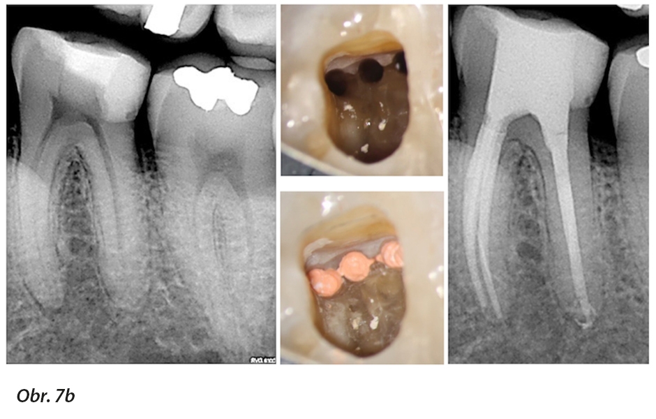 Minimálně invazivní endodoncie, zachování obvodu koronárního dentinu a optimální apikální velikost (se svolením Dr. G. Debeliana)