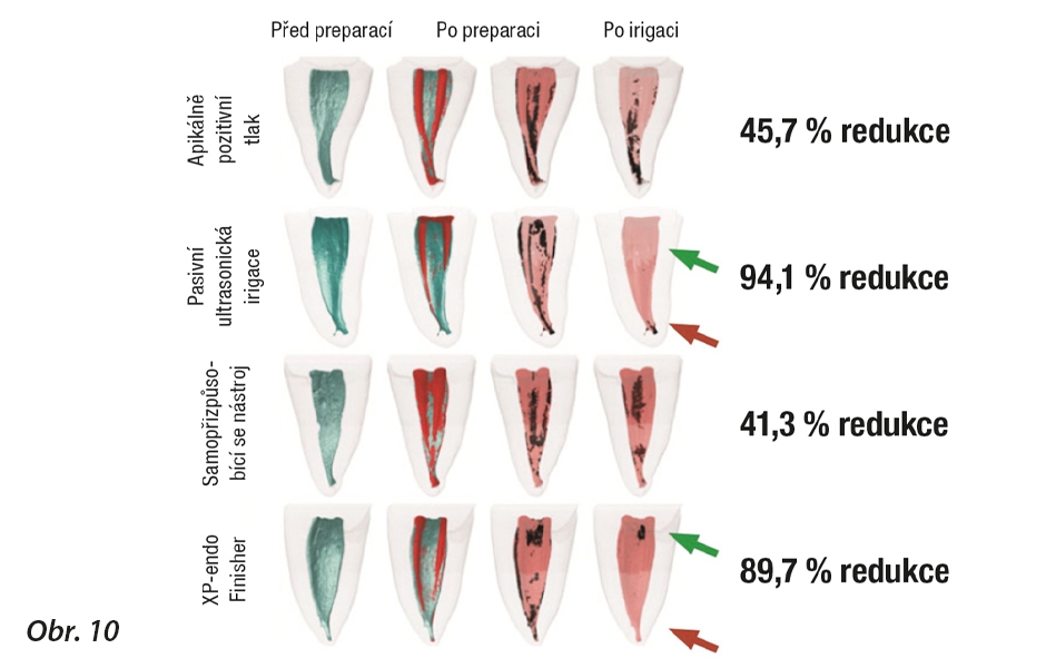 Obrázek odráží distální pohledy na 3D rekonstrukce systému kořenových kanálků meziálního kořene u čtyř dolních molárů před (zeleně) a po (červeně) preparaci kanálků pomocí reciprokačních nástrojů. 