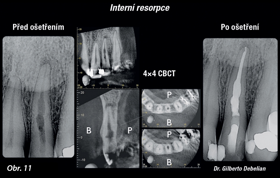 Předoperační periapikální rentgenový snímek ukazuje meziodistální resorpční defekt. Snímky z CBCT ukazují, že se jednalo o vnitřní resorpci a že se také rozšířila bukolingválně.