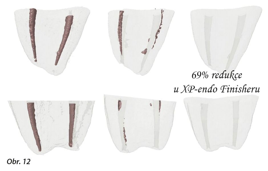 Obrazy mikropočítačové tomografie (μCT) reprezentativních vzorků podrobených reendodonciím. Rekonstruována byla pouze apikální část kořenů. 