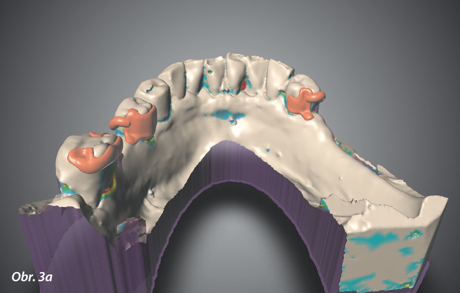 Zhotovení kovových kotevních a spojovacích prvků částečných snímatelných náhrad 3D tiskem