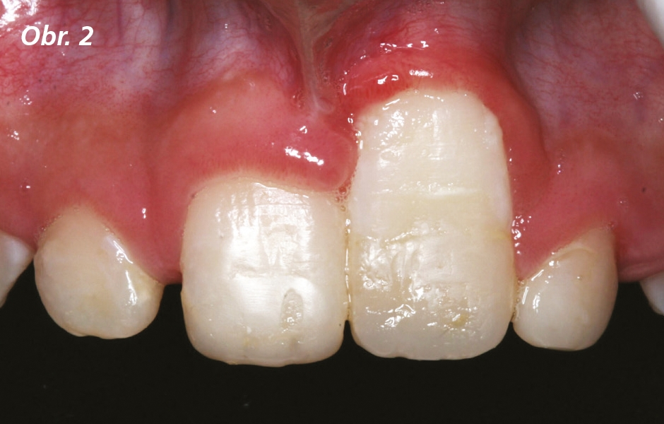 Počáteční situace u zubu 21 a 11. Zub 11 vykazuje výrazný defekt okrajové gingivy