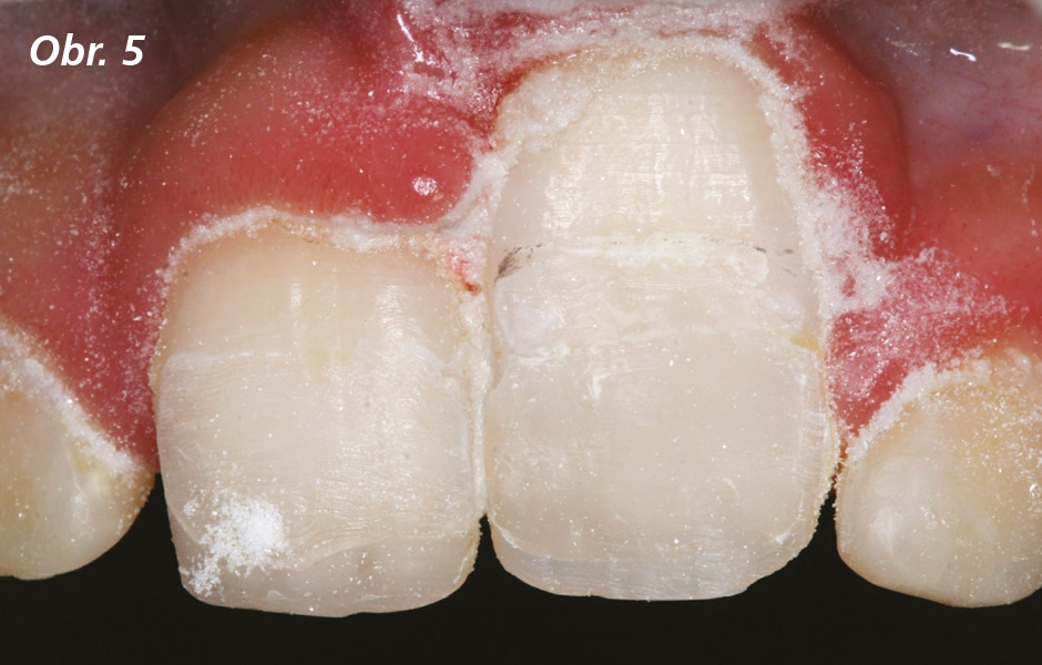 Povrchy zubů opískované oxidem hlinitým