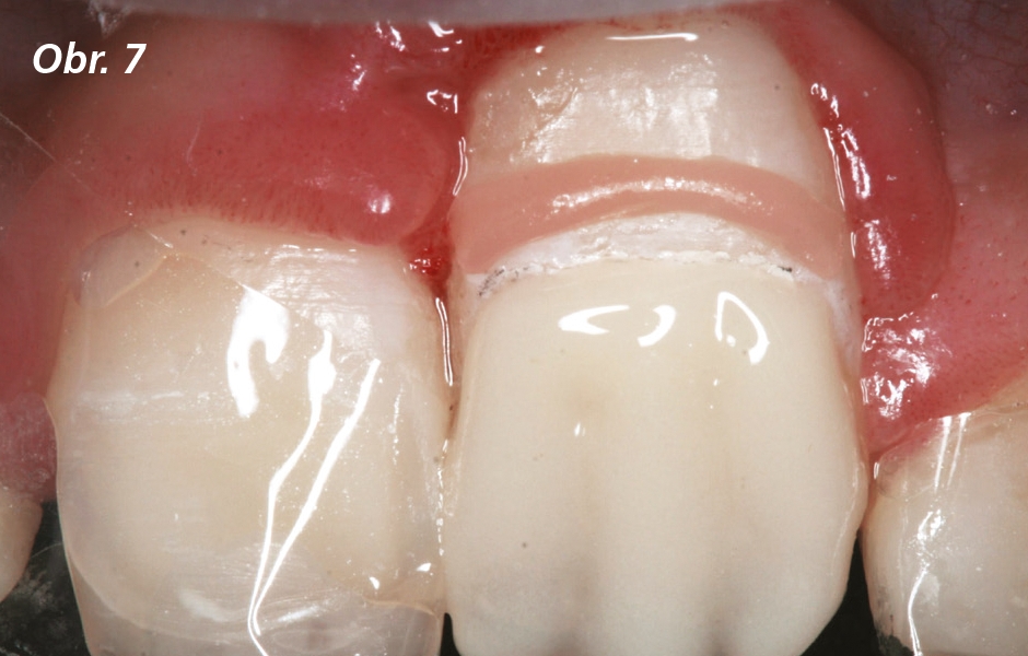 Hranice z kompozitu v barvě dásní označuje výšku rekonstrukce okraje gingivy. Kompozit Amaris v základním opakním odstínu O3 byl nanesen na celý labiální povrch. Dentinová vrstva má tři zvýrazněné mamelony.