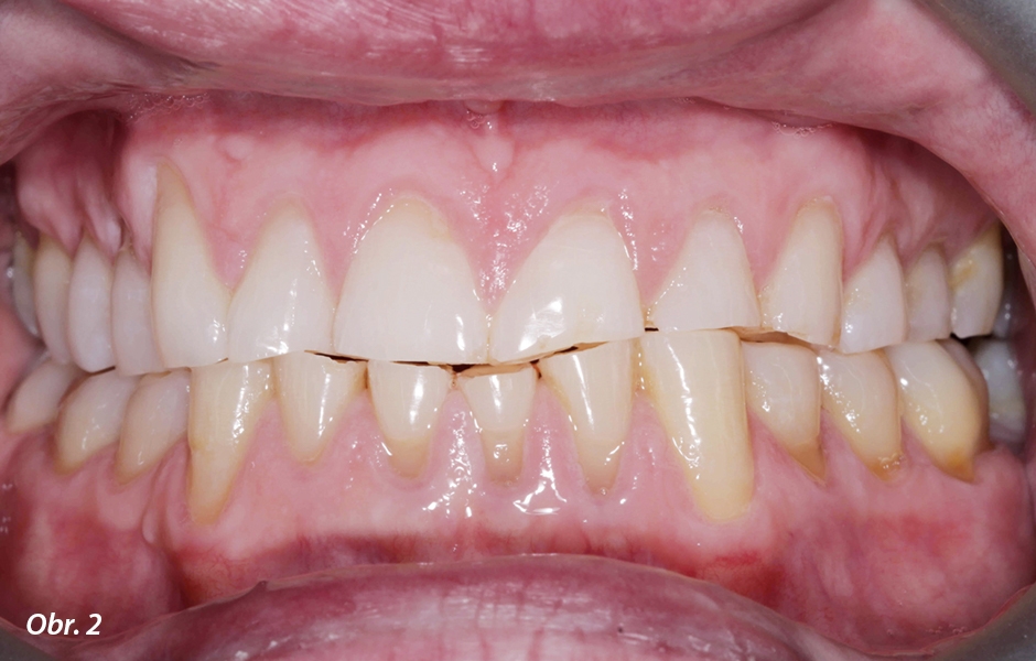 Opotřebení zubů způsobilo zkrácení klinických korunek a kolaps okluzální vertikální dimenze (OVD)