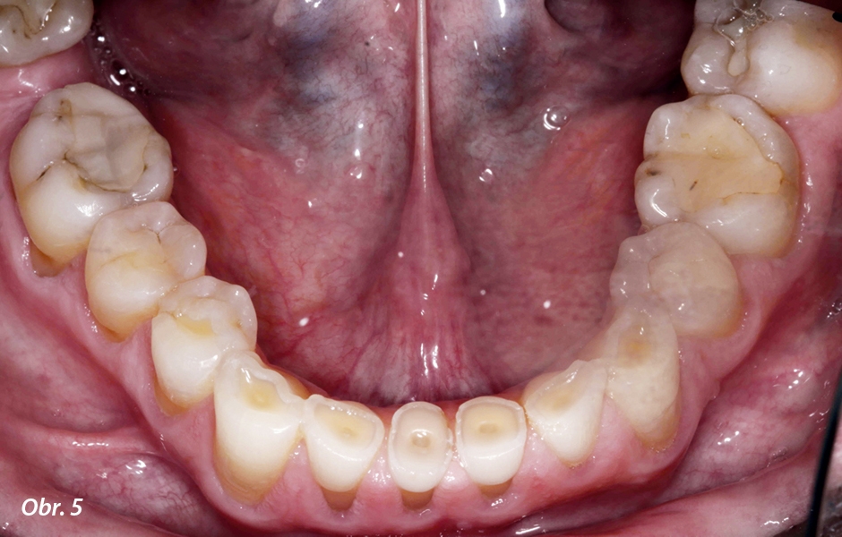 Expozice dentinu byla evidentní, a to především na dolních předních zubech